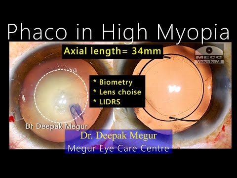 Видео: Факоэмульсификация при сильной миопии: задачи и приоритеты — д-р Дипак Мегур