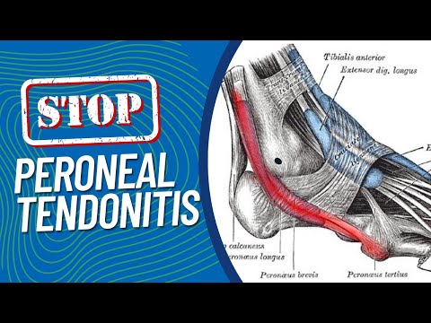 Видео: Научно обоснованные методы лечения тендинита малоберцового сухожилия (боли с внешней стороны стоп...