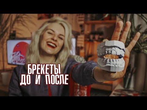 Видео: Брекеты До и После: результат, уход, цена, ретейнеры, капа, отзыв, Омск
