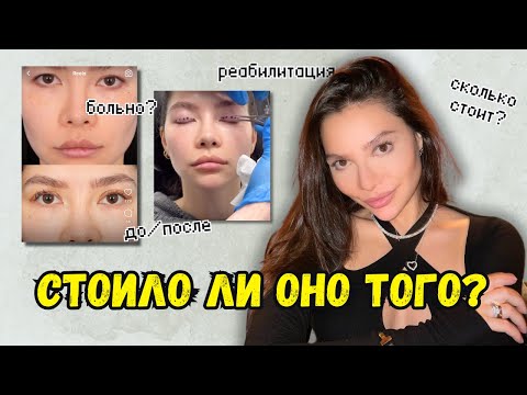 Видео: МОЯ БЛЕФАРОПЛАСТИКА: ДО/ПОСЛЕ, СКОЛЬКО $, РЕАБИЛИТАЦИЯ !