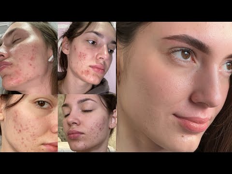 Видео: Бюджетный уход за кожей с акне | Medik 8 или корейская косметика? Честный опыт и советы
