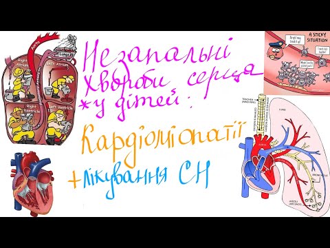 Видео: Запальні та незапальні хвороби серця у дітей. Частина 2: незапальні - Кардіоміопатії + лікування СН