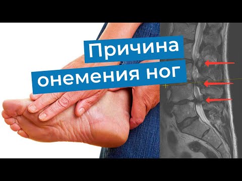 Видео: Частая причина онемения ног - стеноз позвоночного канала