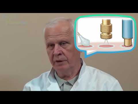 Видео: Удаление контагиозного моллюска выскабливанием, лазером, Сургитроном, жидким азотом