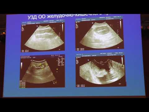 Видео: Иванов В.А. "Диагностические и лечебные миниинвазивные вмешательства под контролем УЗИ"