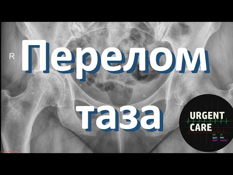 Видео: Перелом таза. Неотложная помощь