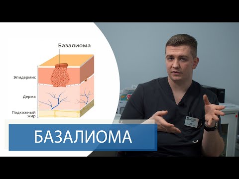 Видео: БАЗАЛИОМА | Базальноклеточный рак кожи | Способы лечения