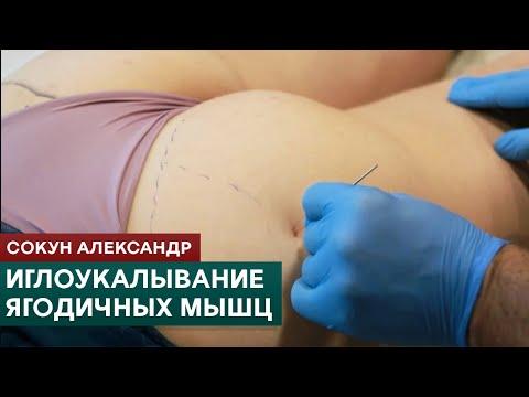 Видео: Иглоукалывание ягодичных мышц. Триггерные точки. Метод сухой иглы. Сокун Александр