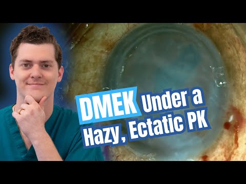 Видео: DMEK под туманным, эктатическим ПК