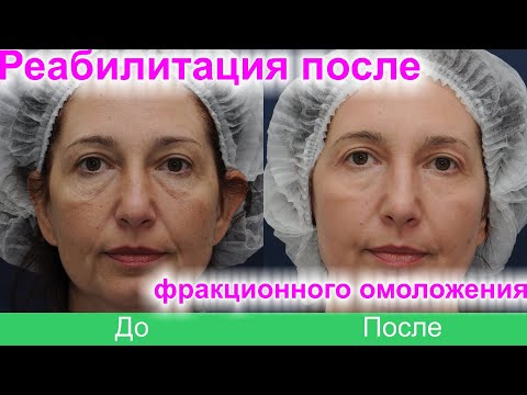 Видео: Фракционное лазерное омоложение. Реабилитация по дням. #12