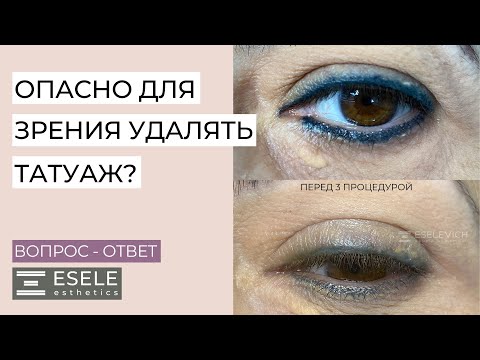 Видео: КАК БЕЗОПАСНО УДАЛИТЬ ПЕРМАНЕНТНЫЙ ТАТУАЖ С ГЛАЗ? Удаление Татуажа Лазером и Ревайвинком.