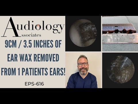 Видео: Удален объем ушной серы в 9 см/3,5 дюйма у одного пациента - EP616