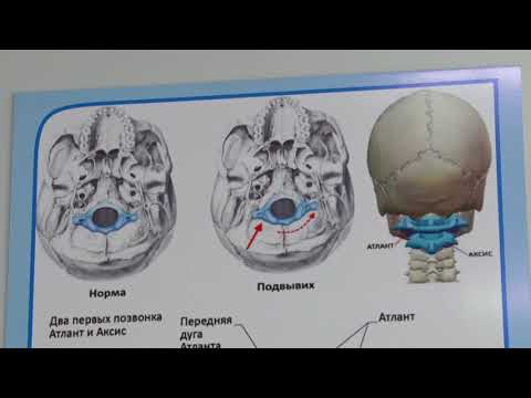 Видео: Дарыгердин кеңеши / Атлант омурткасын түздөө