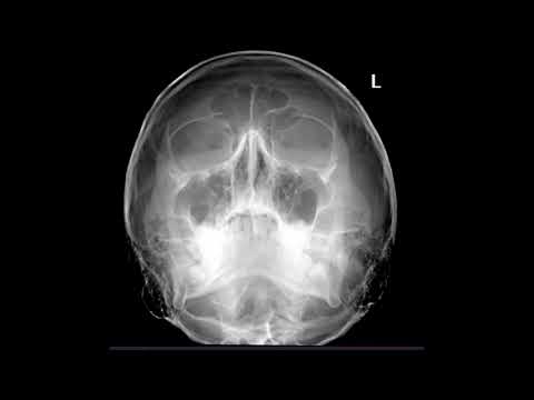 Видео: Укладка для рентгенографии орбиты
