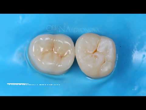 Видео: Fixation VITA Enamic  on a heated composite. Фиксация overlay VITA Enamic на разогретый композит.