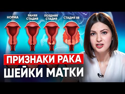 Видео: Рак шейки матки. Симптомы РАКА шейки МАТКИ. Признаки, причины и стадии проявления рака шейки матки.