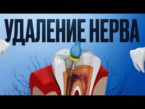 Видео: Удаление нерва. Причины и последствия удаление. Лечение пульпита и зубных каналов. Стоматология