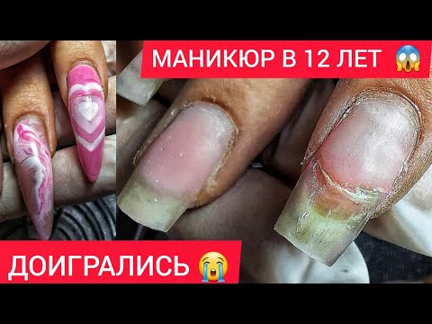 Видео: БОЛЯТ ВСЕ НОГТИ 😭 ТРЕЩИНА ПО МЯСУ 🤢МАНИКЮР  В 12ЛЕТ