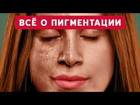 Видео: Как УСТРАНИТЬ появление ПИГМЕНТНЫХ ПЯТЕН на коже? / Интервью с ЭНДОКРИНОЛОГОМ