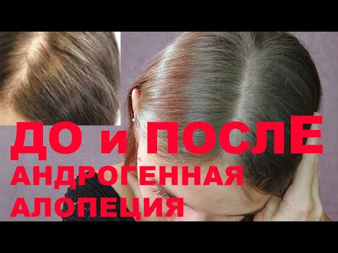 Видео: Женское облысение. Андрогенная алопеция. Как востановить красивые волосы