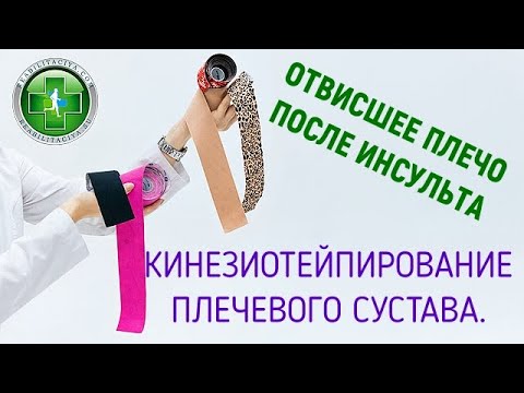 Видео: Отвисшее плечо парализованной руки после инсульта. Одно из эффективных решений - кинезиотейпирование