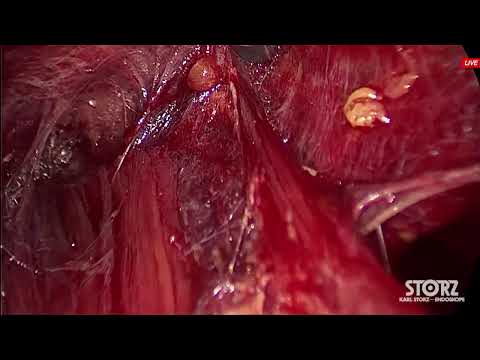 Видео: Мастер-класс по трансаксиллярной тиреоидэктомии. Начало 24 сентября в 9:00 по МСК