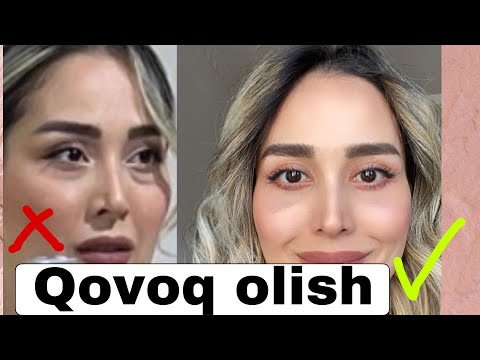 Видео: Qovoq olish operatsiya,блефаропластика,qovoqdan butunlay qutilish, qovoq ko’tarish,grijani oldirish,
