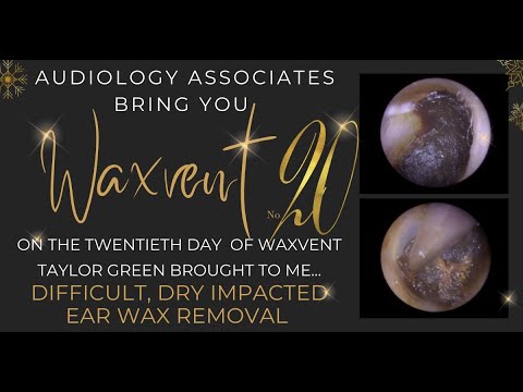 Видео: СЛОЖНОЕ, ЗАПОЛНЕННОЕ УШНОЙ СЕРЫ СУХОЕ УШНОЕ УДАЛЕНИЕ - EP539