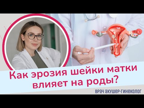 Видео: Как эрозия шейки матки влияет на роды? | Виктория Матвиенко