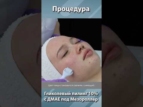 Видео: Процедура Гликолевый пилинг 10% с ДМАЕ под Мезороллер #skincare #акне #косметолог #пилинг