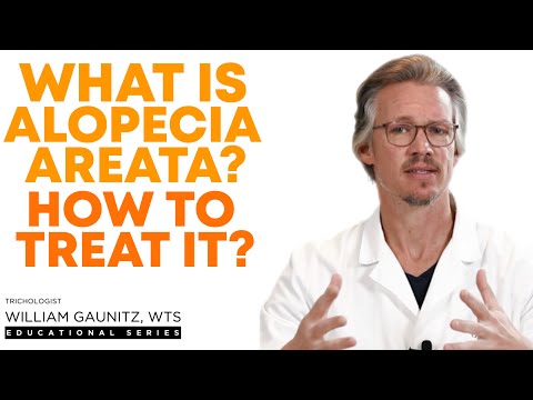 Видео: Признаки, причины и лечение гнездной алопеции | Путь к выздоровлению от гнездной алопеции