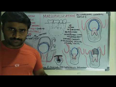 Видео: Марсупиализация