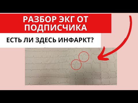 Видео: Разбор ЭКГ от подписчика. Можно ли увидеть инфаркт при кардиостимуляторе?
