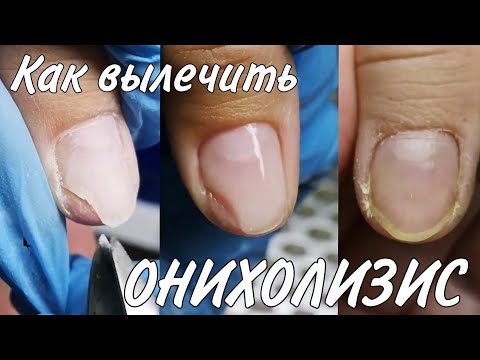 Видео: Онихолизис - ноготь отошёл от кожи. Что делать? Пустота под ногтем. Причины, обработка, лечение
