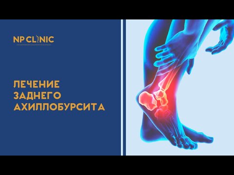 Видео: Лечение заднего ахиллобурсита