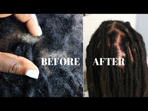 Видео: Как удалить чешуйки и перхоть | Чрезвычайно сухая кожа головы, псориаз и дерматит