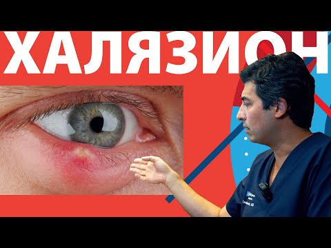 Видео: ХАЛЯЗИОН, что это такое? как лечить,  какие могут быть последствия