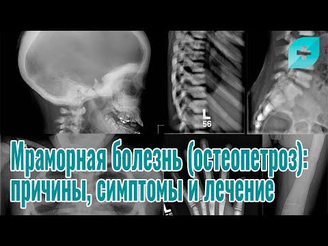 Видео: Мраморная болезнь (остеопетроз): причины, симптомы и лечение