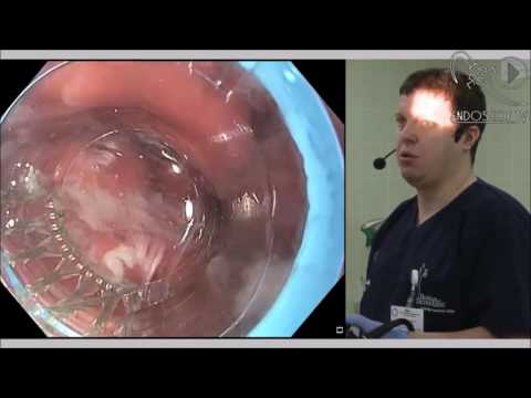 Видео: Лигирование варикозно расширенных вен пищевода (запись прямой трансляции)