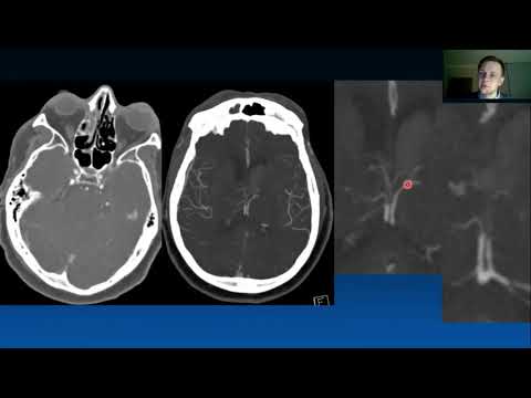Видео: Дроздов А.А. Ишемические инсульты и КТ диагностика. Роль рентгенолога и состояние проблемы