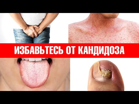 Видео: Примените эти 6 средств, и кандидоз никогда не вернется👍