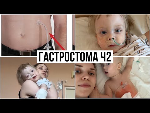 Видео: Установка Гастростомы и Осложнения