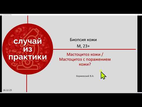 Видео: Мастоцитоз в коже