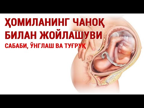 Видео: ҲОМИЛАНИНГ ЧАНОҚ БИЛАН ЖОЙЛАШУВИ: сабаби, ўнглаш ва туғруқ