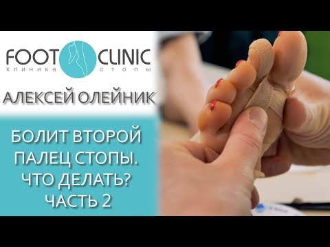 Видео: Молоткообразная деформация  2-го пальца. Часть 2.
