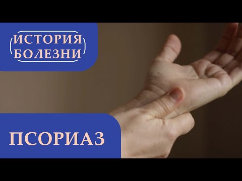 Видео: Псориаз | «История болезни»