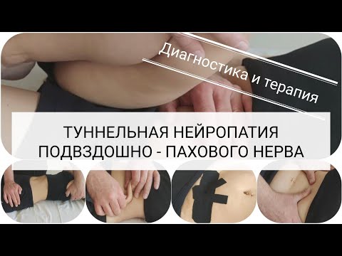 Видео: Боль и онемение в паховой области/ Протокол терапии /Tunnel neuropathy of the ilioinguinal nerve