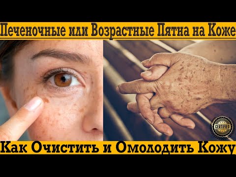 Видео: Печёночные или возрастные пятна на коже лица и рук! Как очистить и омолодить кожу?!