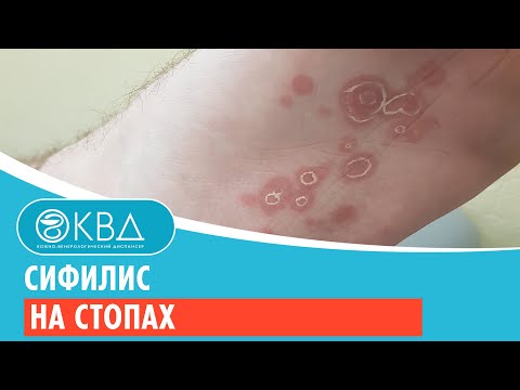 Видео: 🦶 Сифилис на стопах. Клинический случай №916