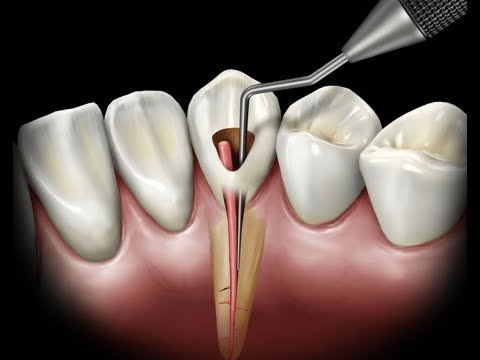 Видео: Пломбирование корневых каналов